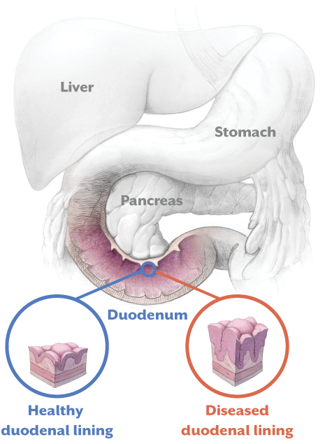 Healthy duodenal lining VS. Diseaseed duodenal lining
